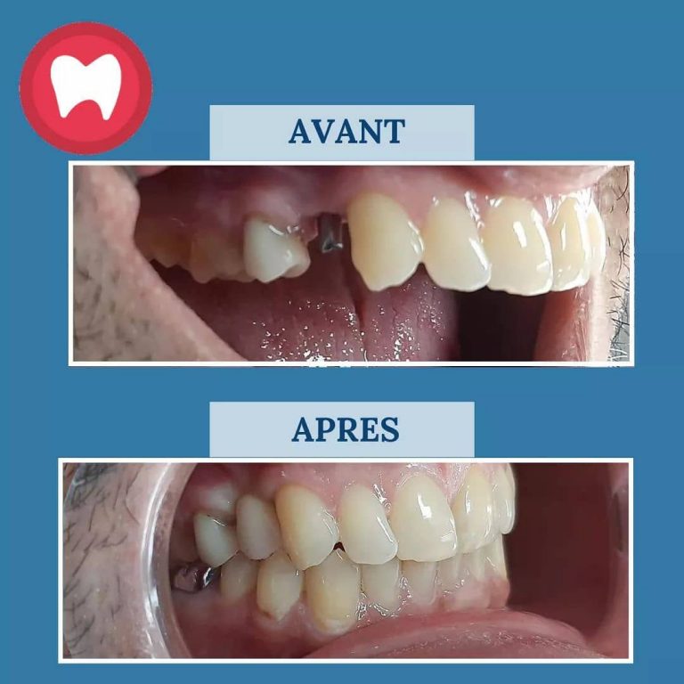Combien Coute Un Implant Dentaire Au Maroc