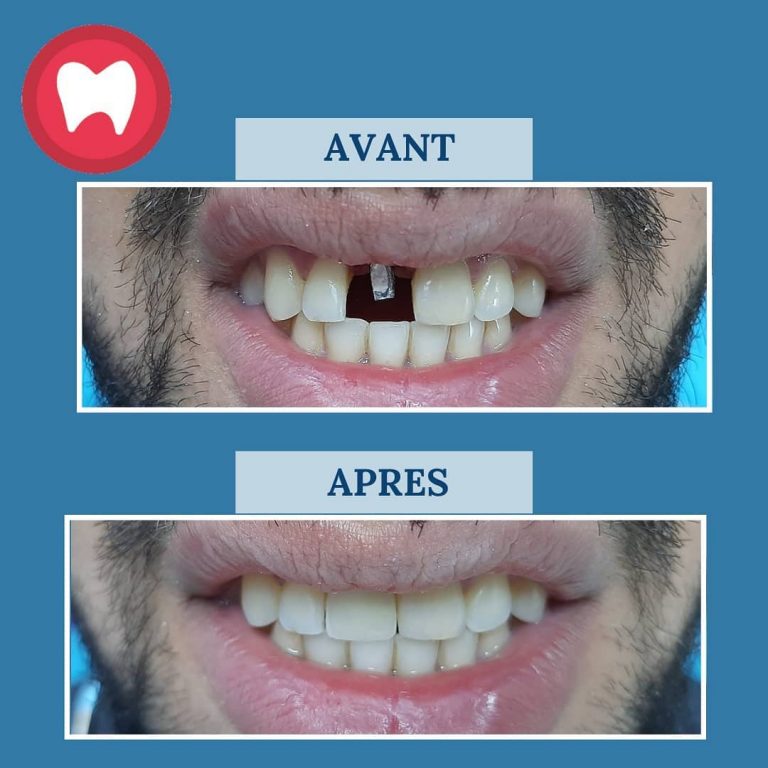 Combien Coute Un Implant Dentaire Au Maroc