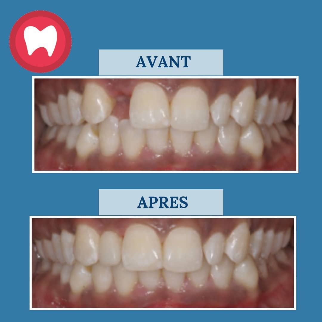 Combien Coute Un Implant Dentaire Au Maroc