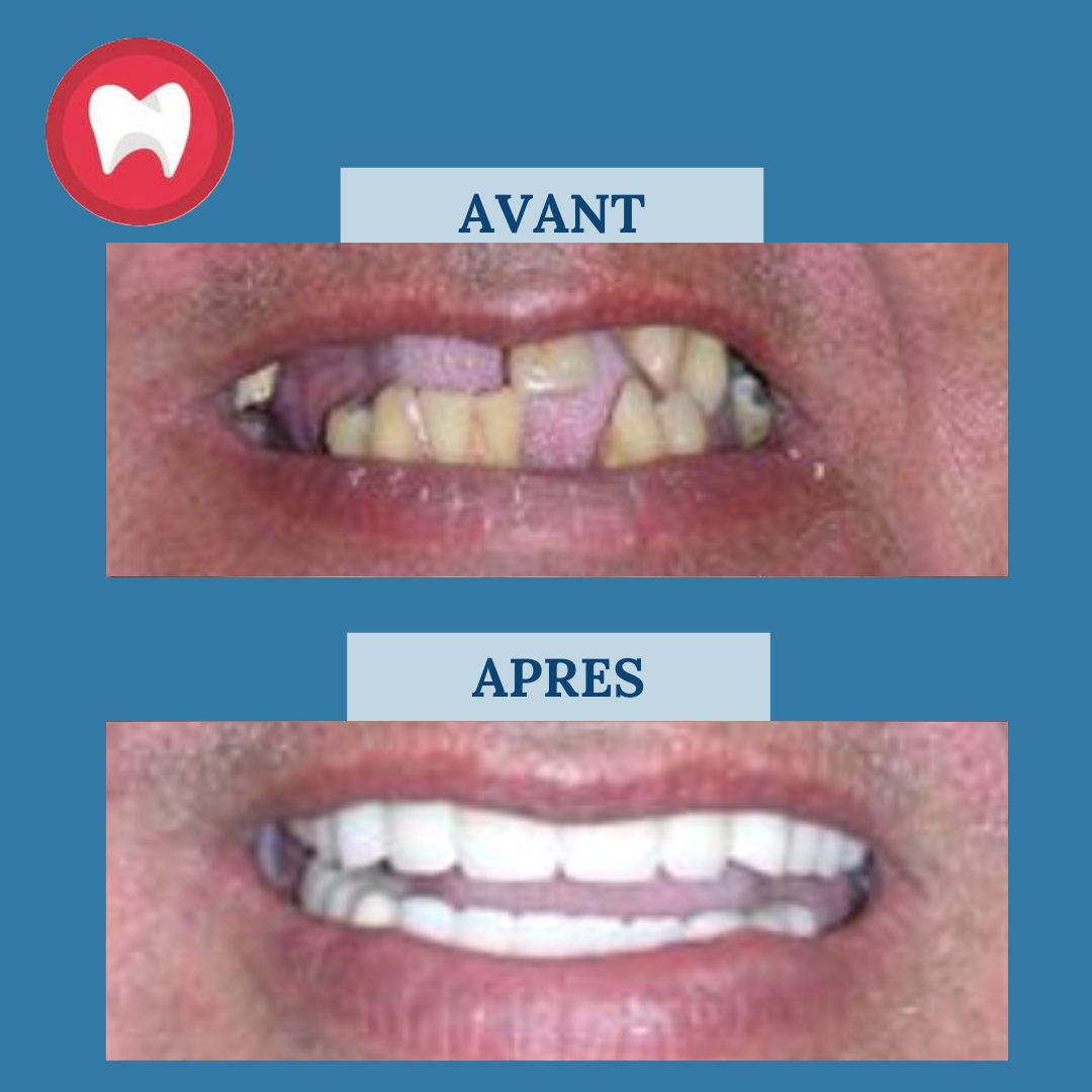 Bridge complet sur implants au Maroc Prix, résultats... Clinique la — free download
