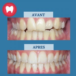 Prix Traitement Invisalign au Maroc - Clinique Dentaire la Colline