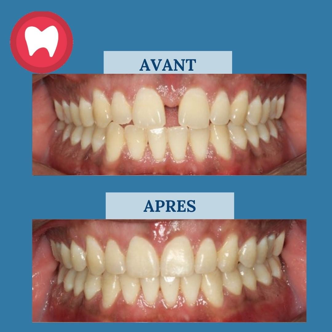 Combien Coute Un Implant Dentaire Au Maroc
