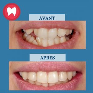 Prix Traitement Invisalign au Maroc - Clinique Dentaire la Colline