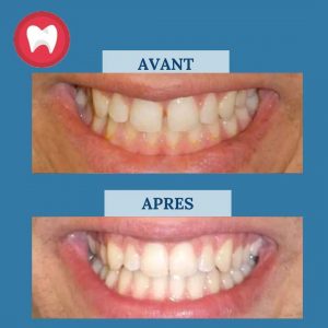 Prix Traitement Invisalign au Maroc - Clinique Dentaire la Colline